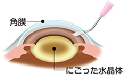 水晶体摘出1