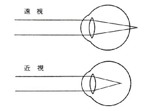 屈折異常（遠視・近視・乱視）について