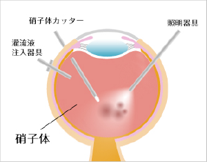 まず白目の部分に手術機器を挿入する小さな穴を3ヶ所あけます